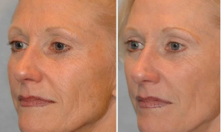 laser biorivitalizzazione